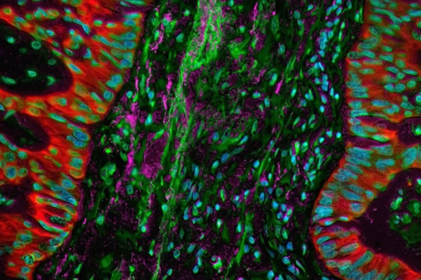 Микроскопические изменения клеток связаны с быстрым ростом рака в жестких тканях